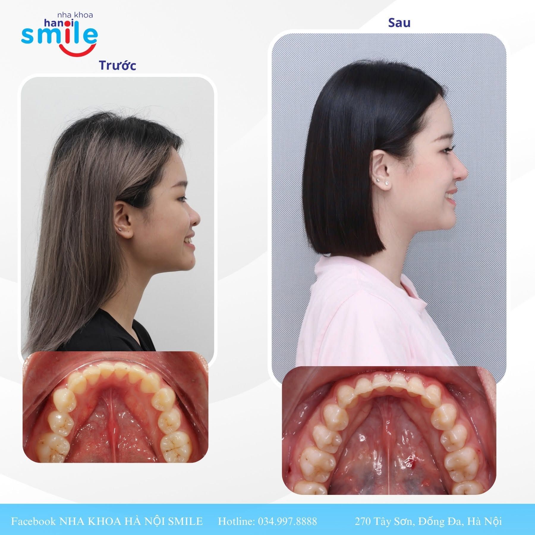 Ca chỉnh nha 1: ảnh nhìn nghiêng và cung răng hàm dưới trước, sau điều trị