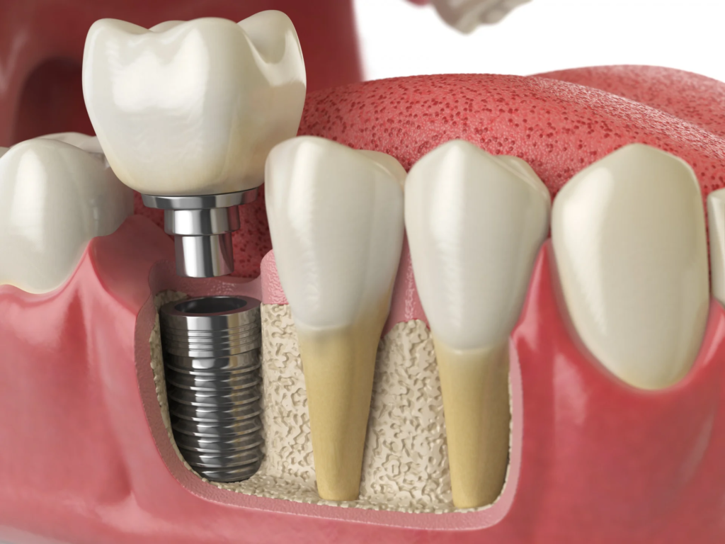 Trụ Implant Mỹ