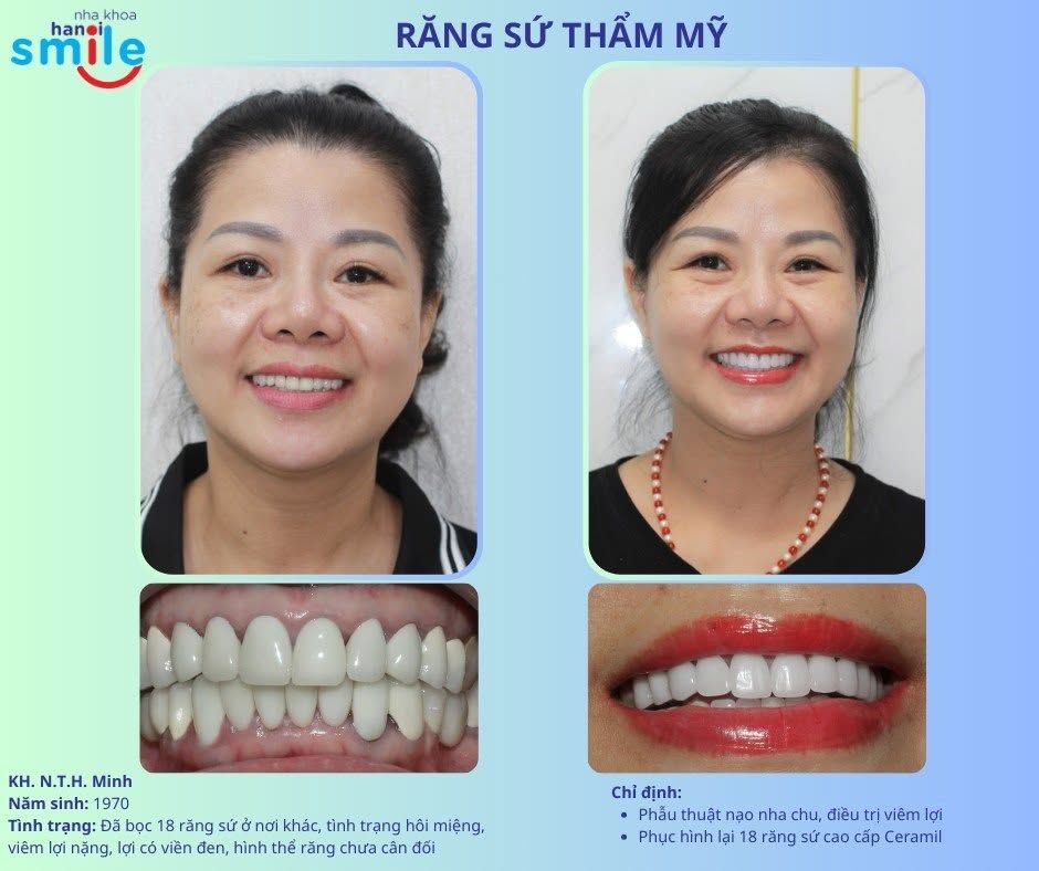 Làm Lại Răng Sứ Bị Viêm Lợi, Đen Viền: Điều Trị Nha Chu Trước, Phục Hình Sau