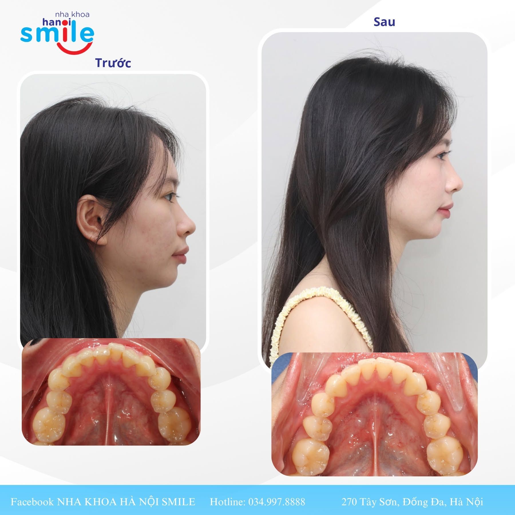 Ca chỉnh nha 2: cung răng hàm dưới trước, sau điều trị