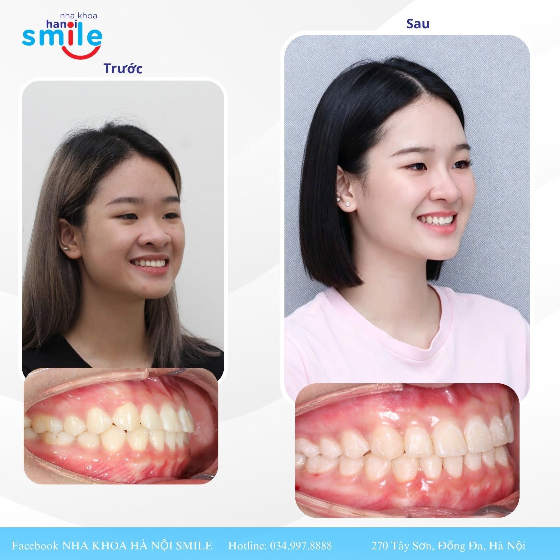 Ca chỉnh nha 1: ảnh nghiêng và khớp cắn bên trước, sau điều trị