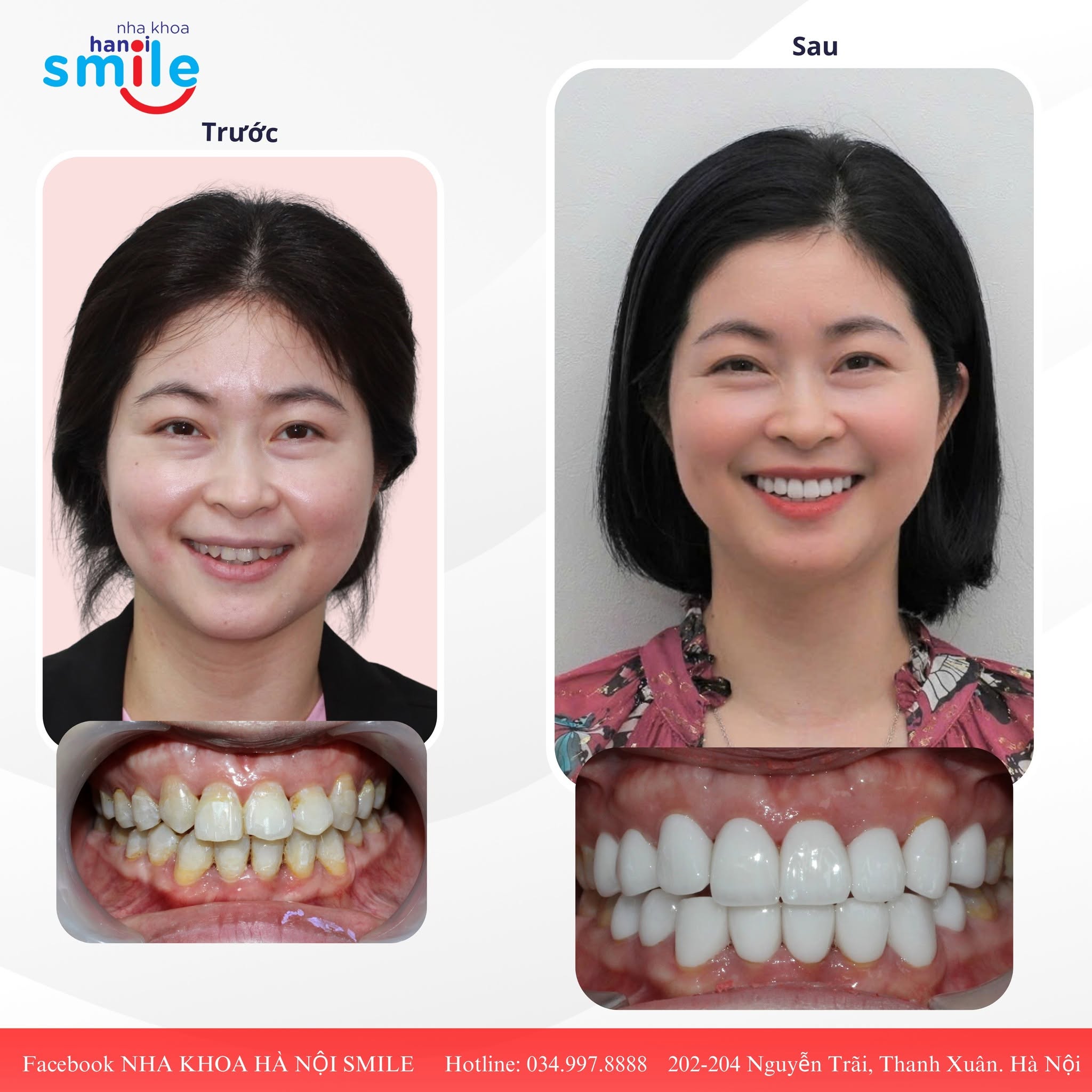 Bọc Răng Sứ Thẩm Mỹ Cho Răng Nhiễm Màu Kháng Sinh Lâu Năm