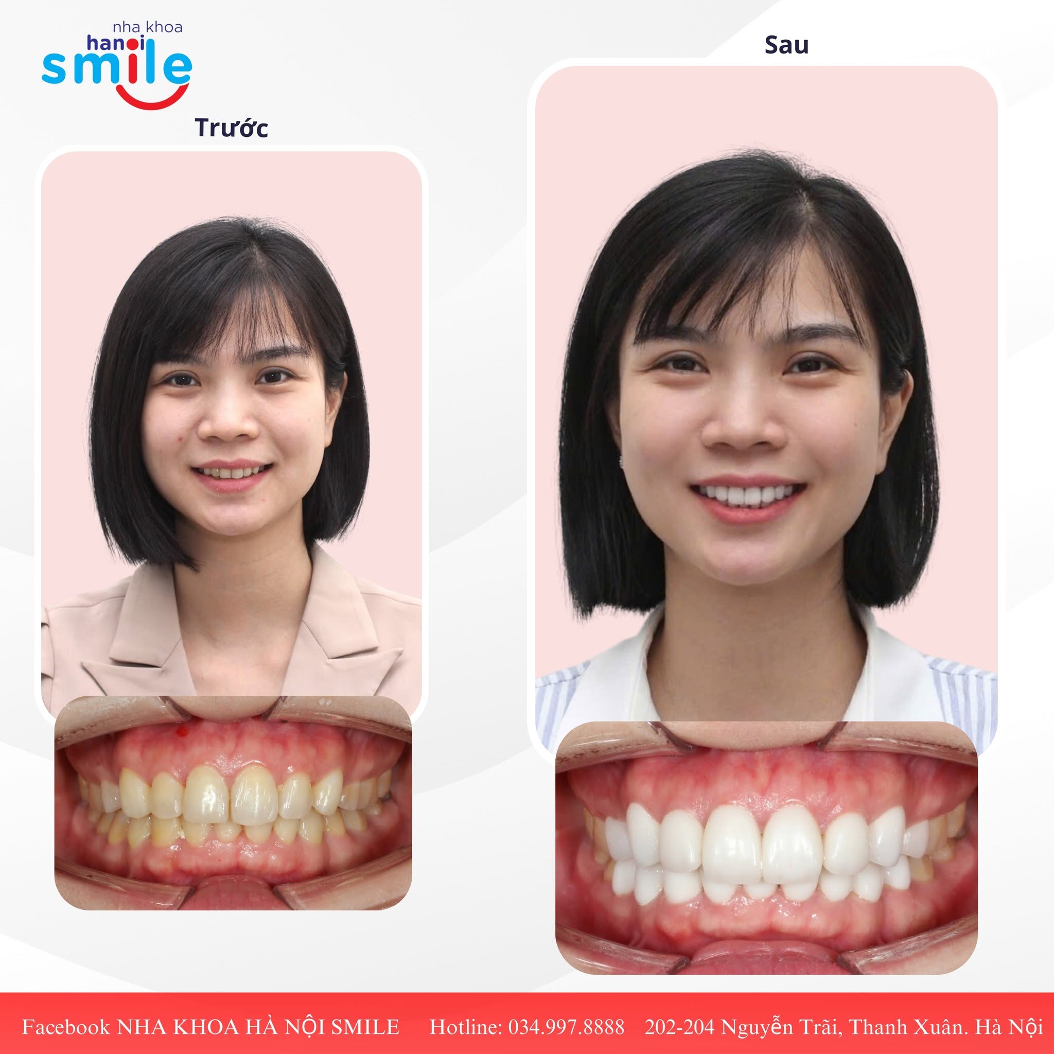 Tự Tin Thuyết Trình Sau Khi Cải Thiện Nụ Cười