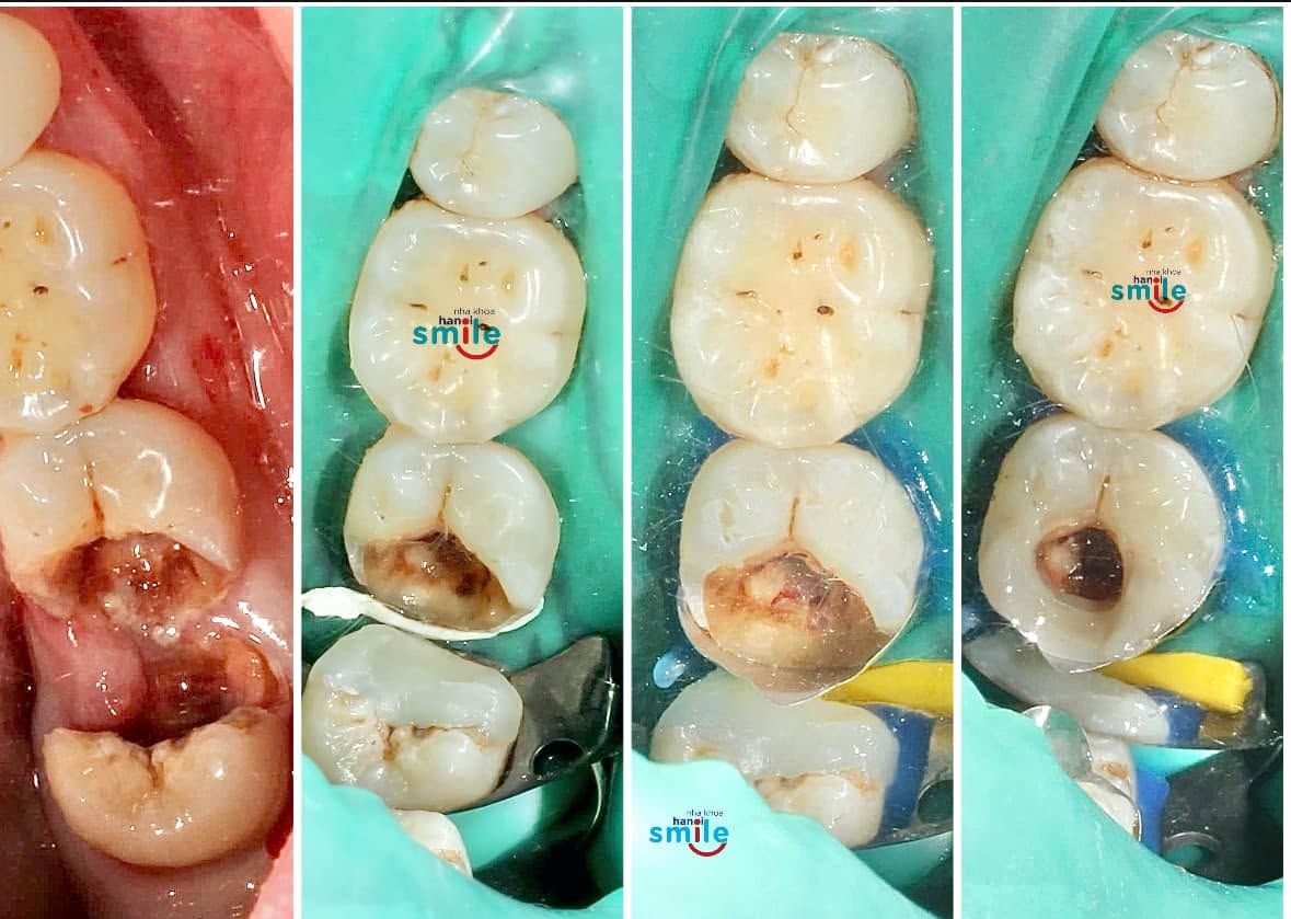 Các bước làm sạch mô sâu trên răng hàm dưới, thực hiện dưới đê cao su