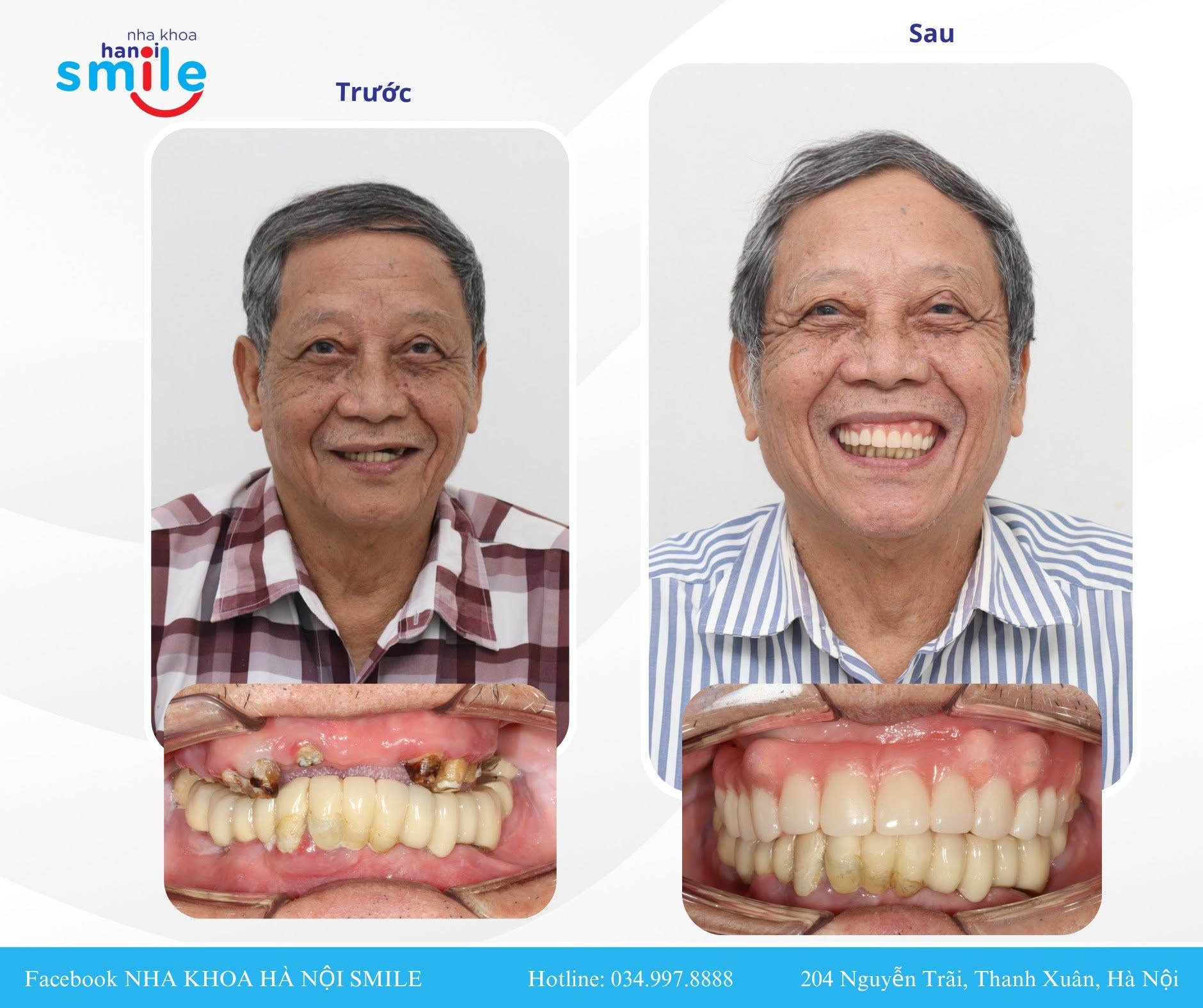 Món Quà Cho Cha Mẹ: Chủ Động Phục Hồi Răng Mất
