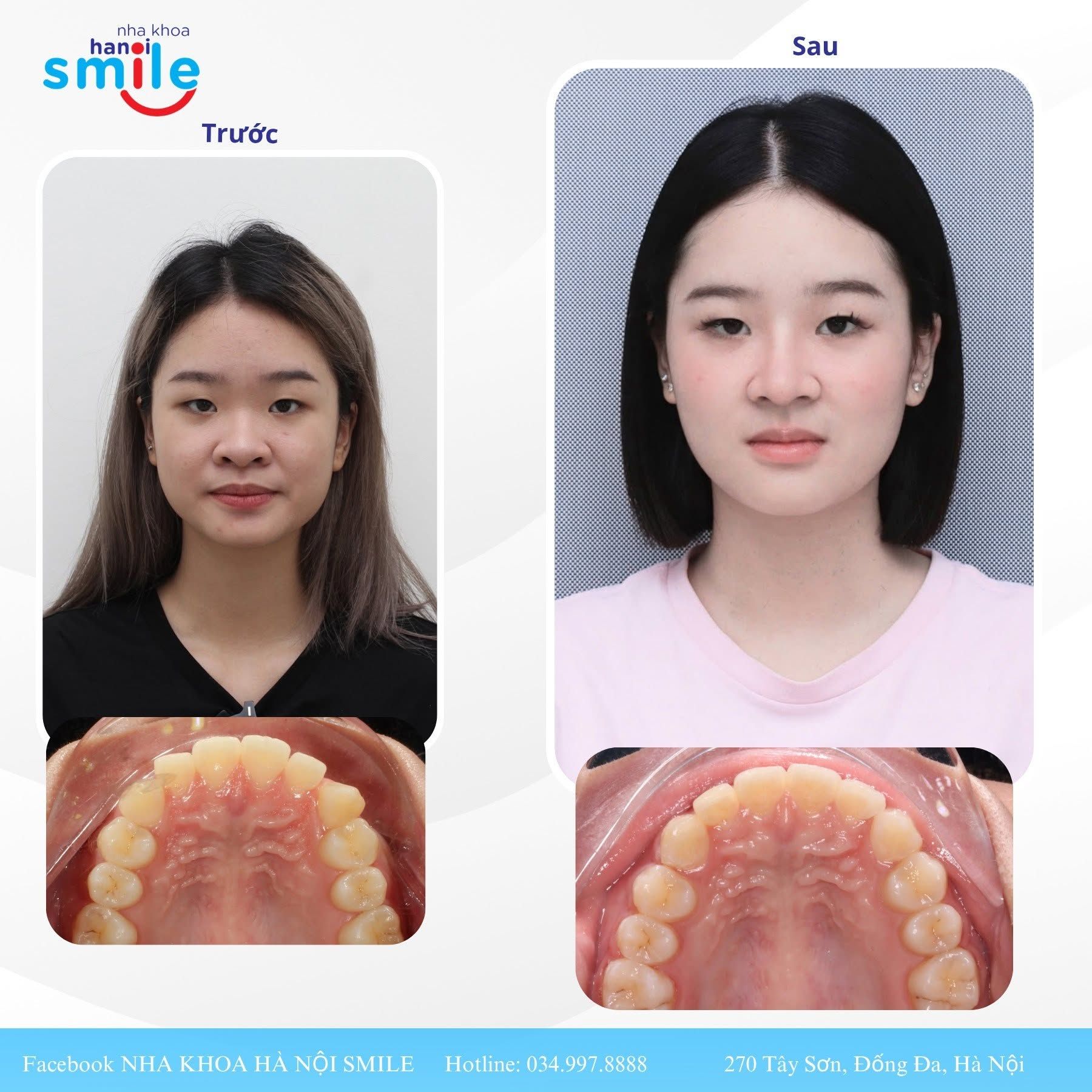 Ca chỉnh nha 1: cung răng hàm trên trước, sau điều trị