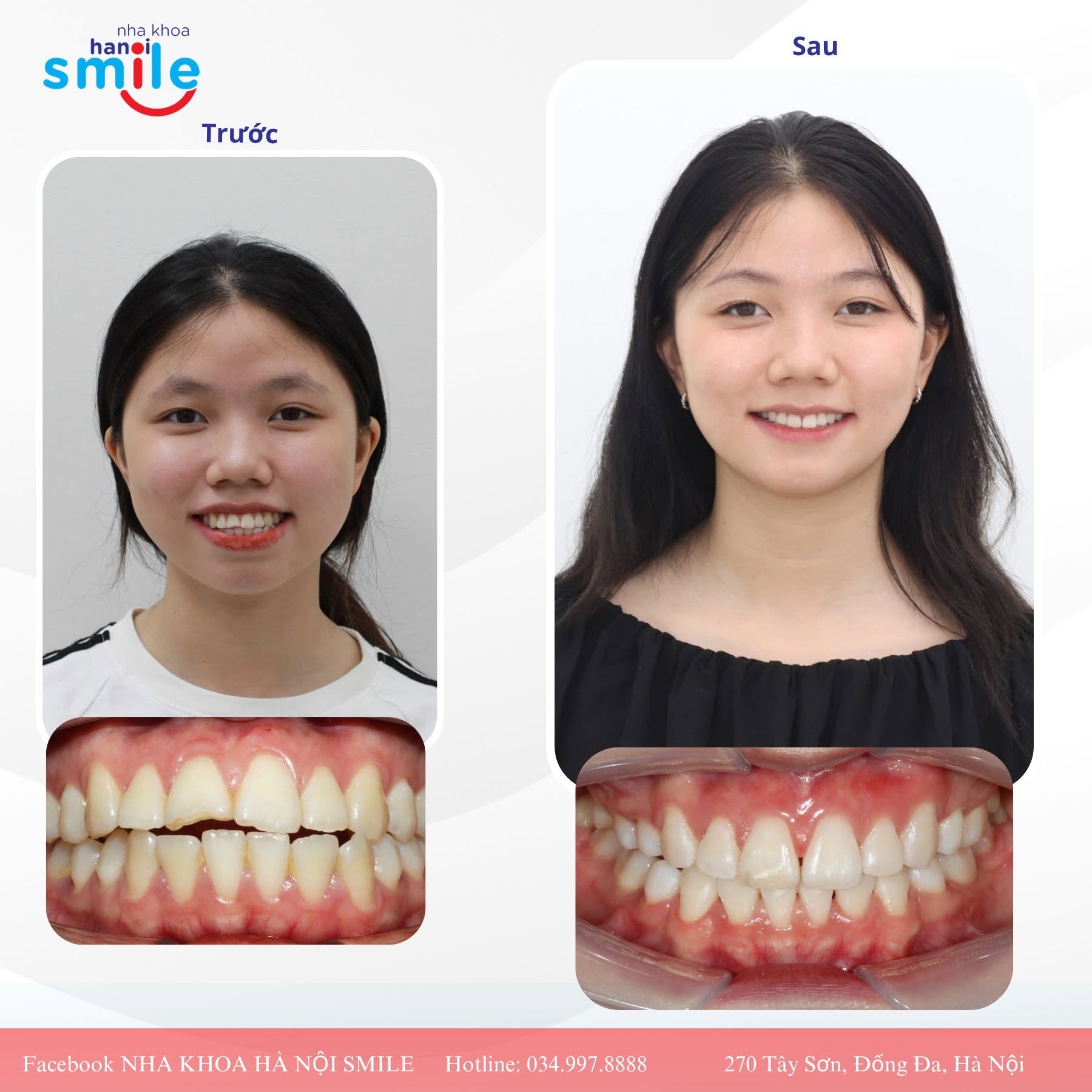 Hành Trình Chỉnh Nha Của Một Cô Gái Trẻ