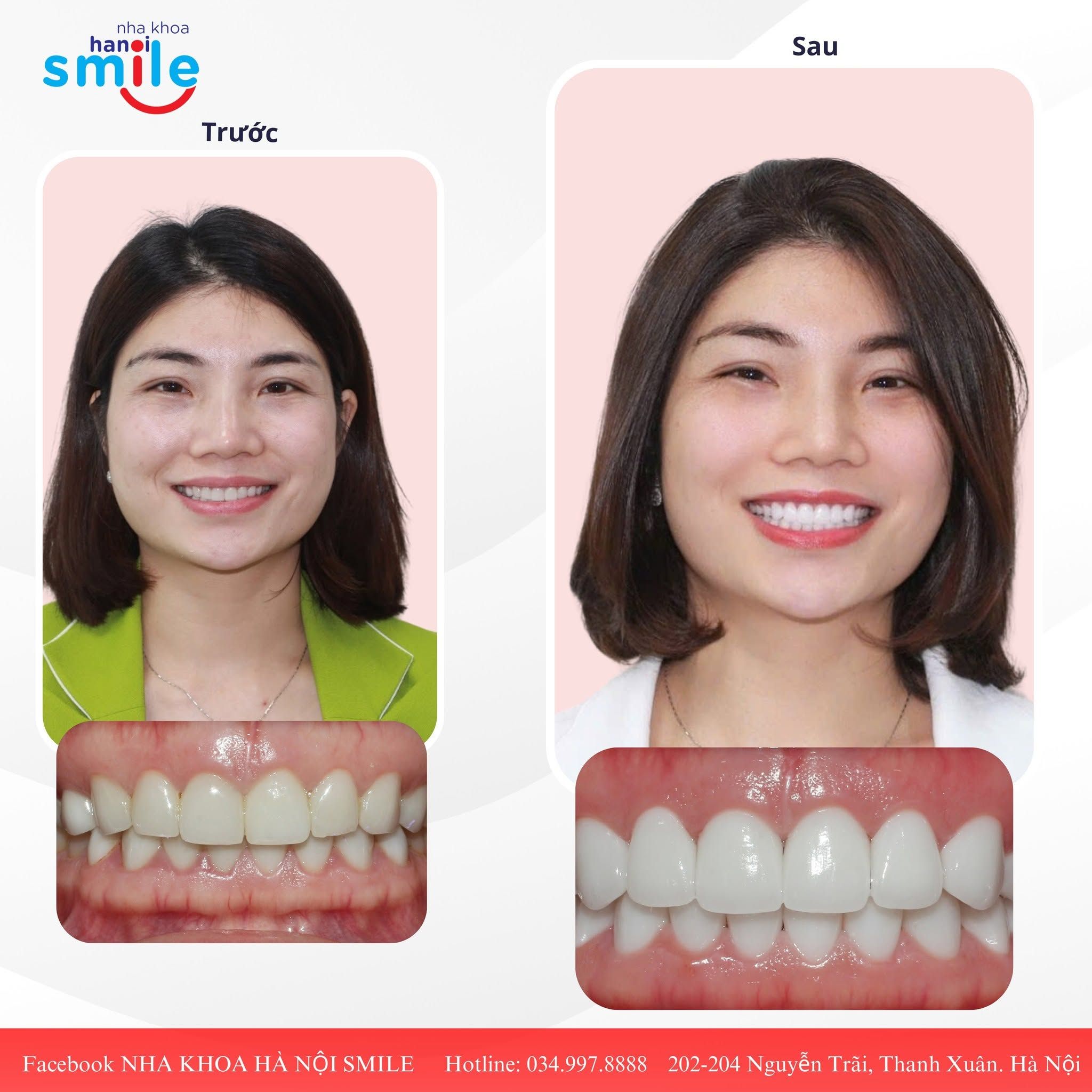 Ca phục hình răng sứ 3: ảnh trước và sau điều trị