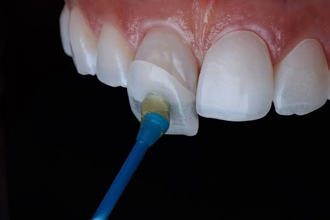 Mặt Dán Sứ / Phục Hình Thẩm Mỹ