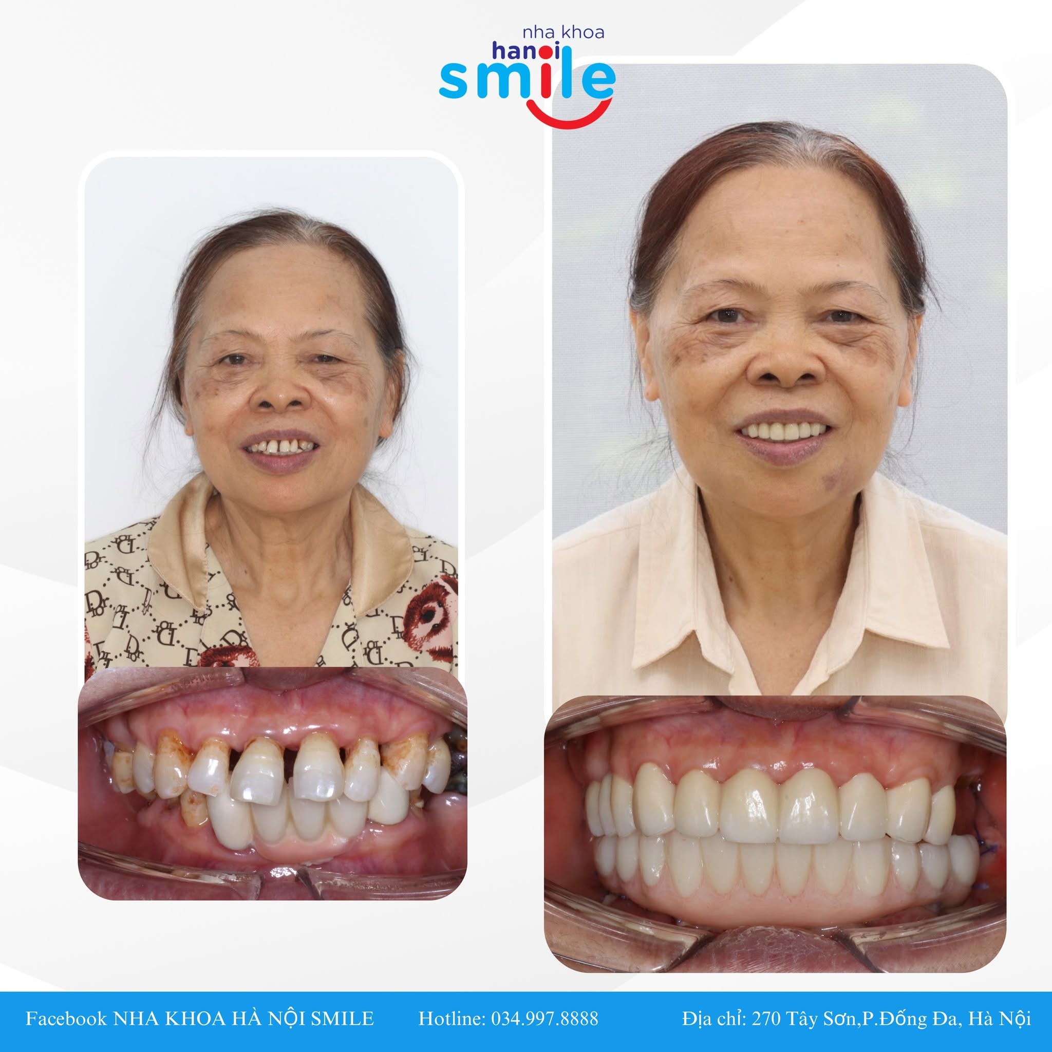 Phục Hồi Toàn Hàm Bằng Kỹ Thuật Implant All-on-4
