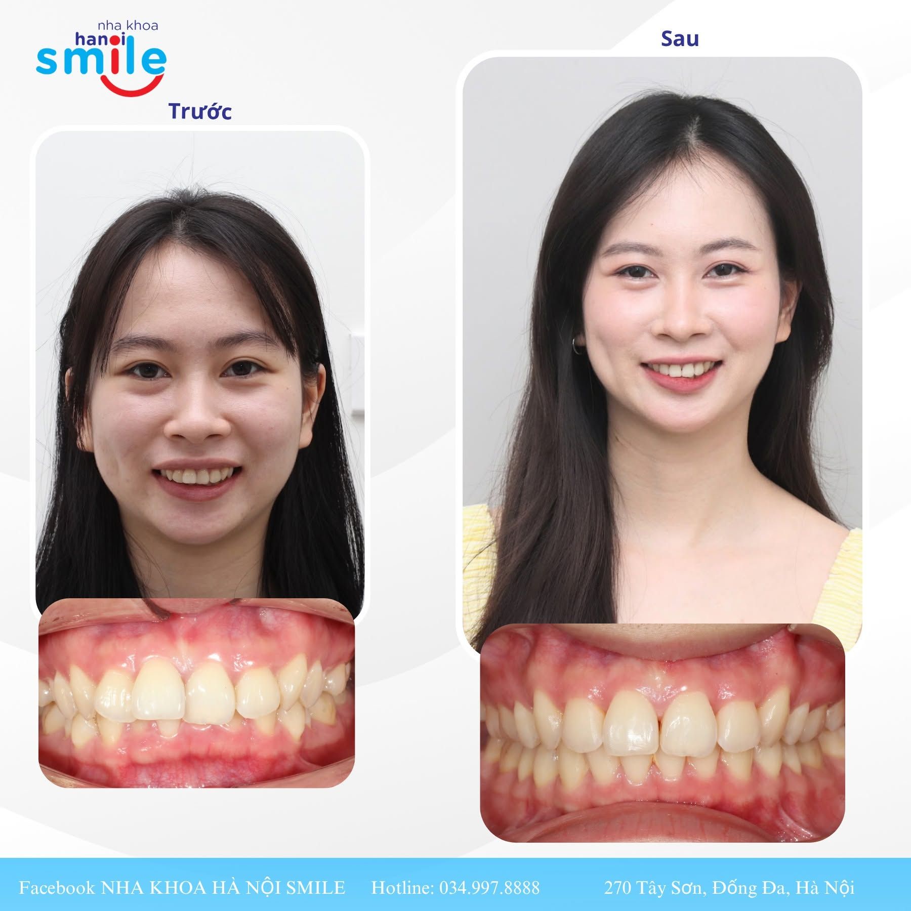 Ca chỉnh nha 2: ảnh chính diện và khớp cắn trước, sau điều trị