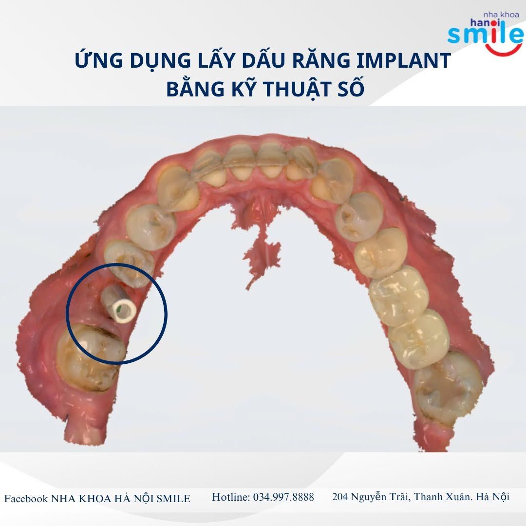 Lấy Dấu Răng Implant Bằng Kỹ Thuật Số: Quy Trình Và Lợi Ích