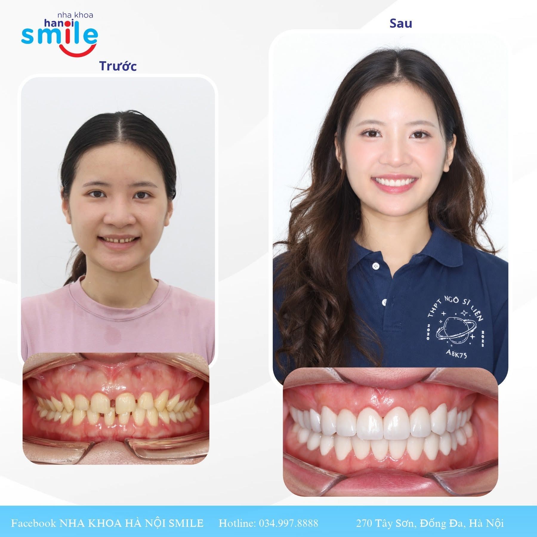 Phục Hình Sứ Cho Răng Thưa: Ca Lâm Sàng Và Các Lựa Chọn Điều Trị