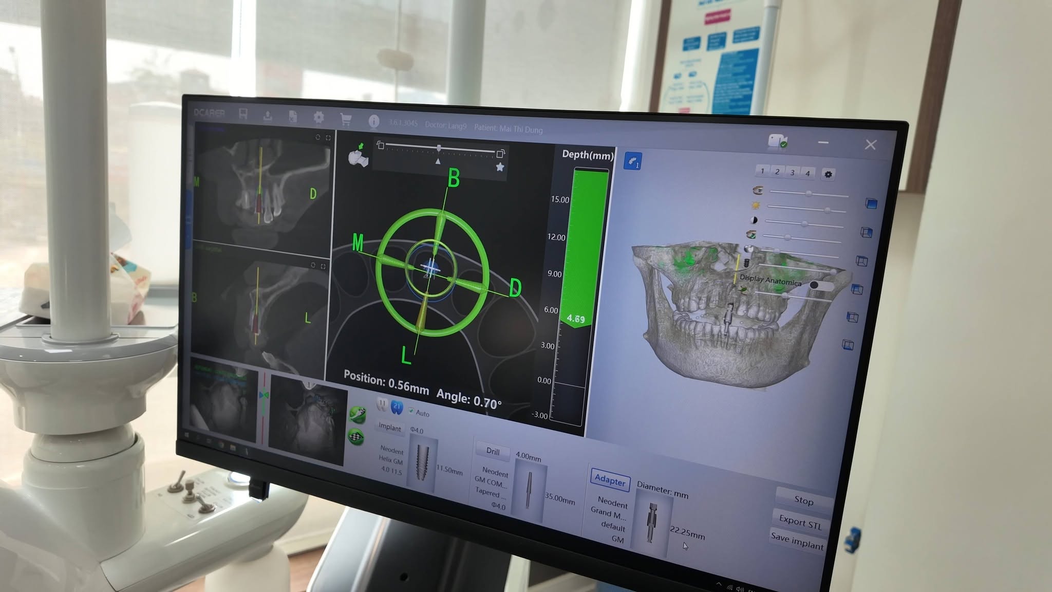 Cấy Ghép Implant