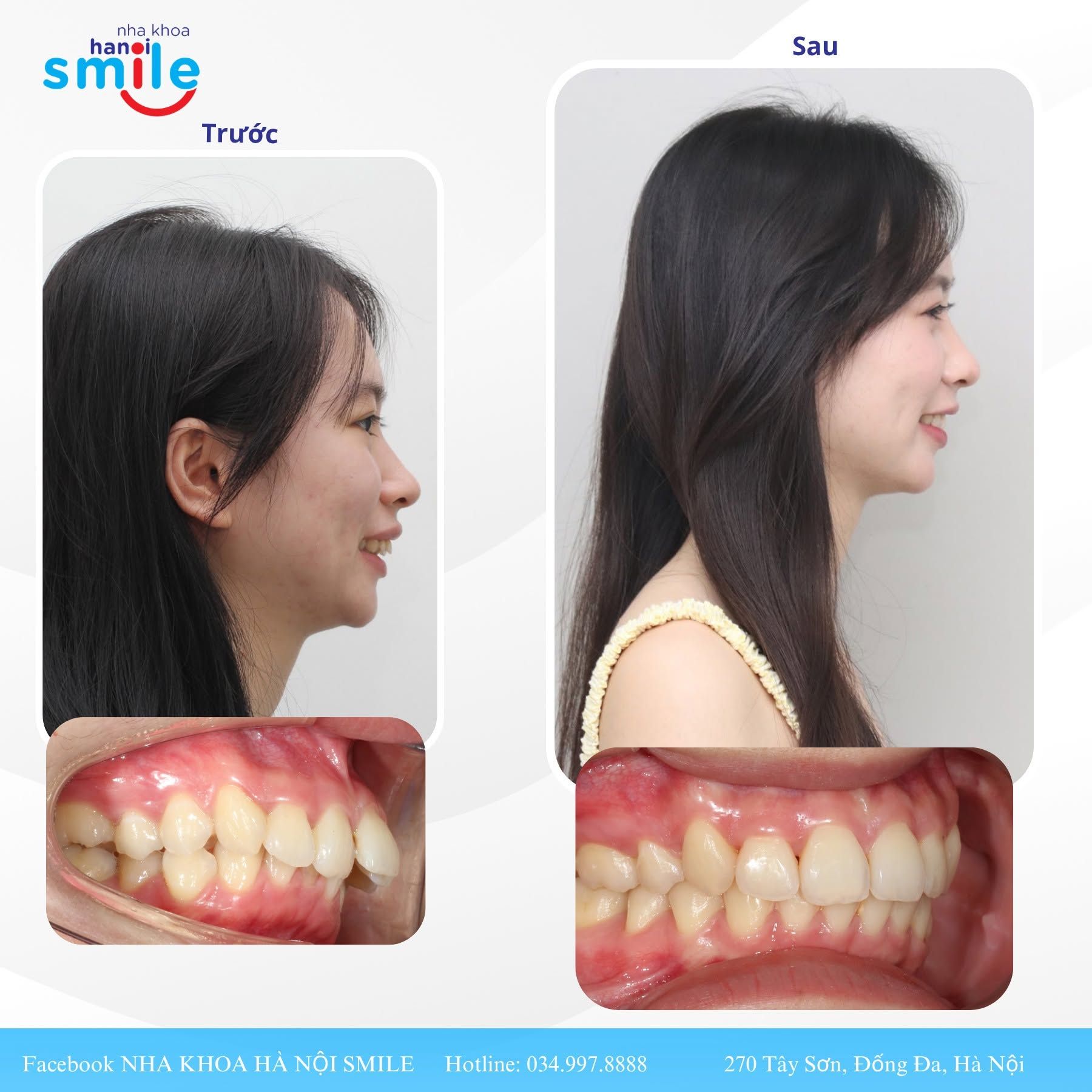 Ca chỉnh nha 2: ảnh nhìn nghiêng và khớp cắn bên trước, sau điều trị