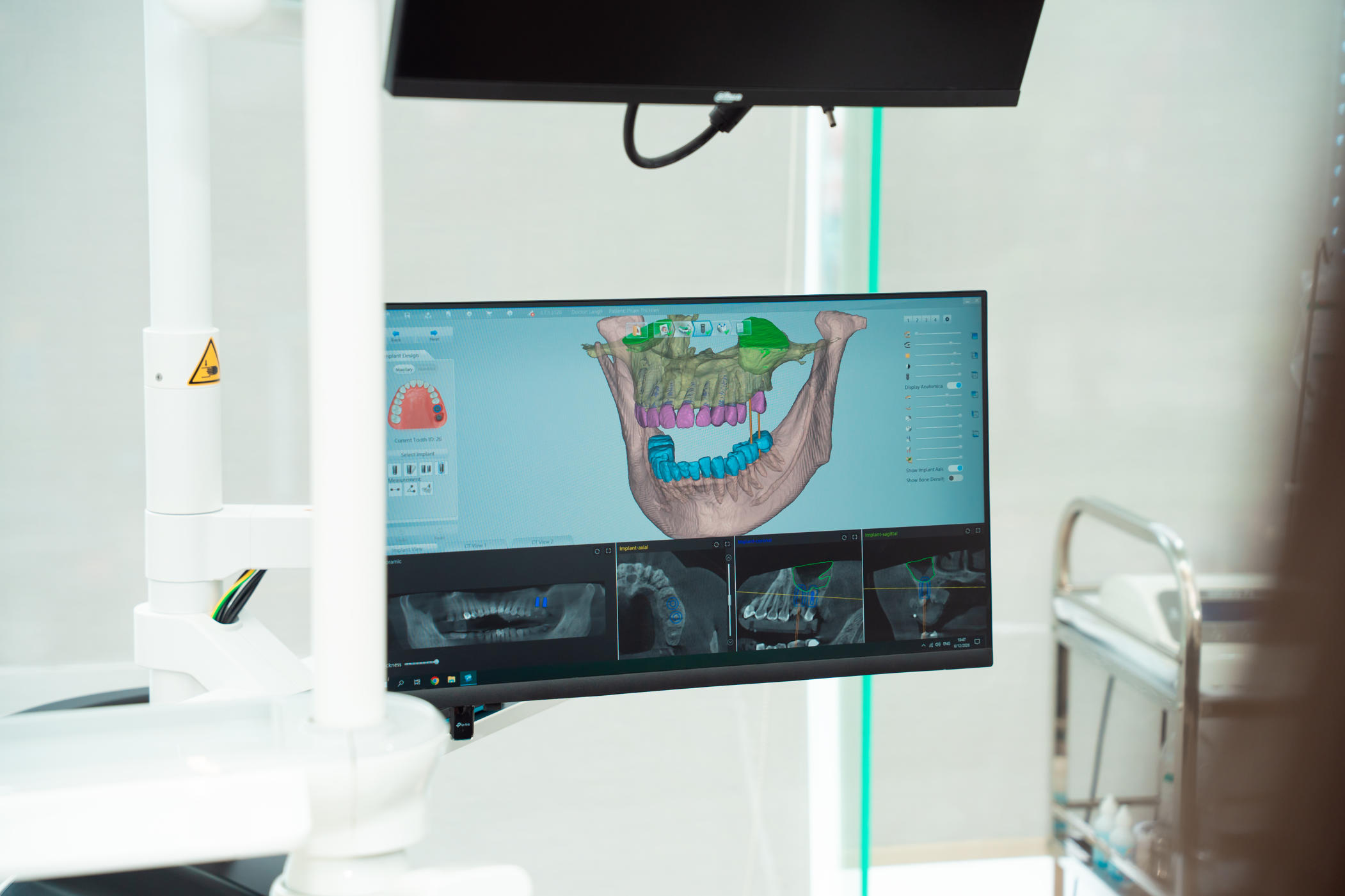 Cấy Ghép Implant Là Gì?