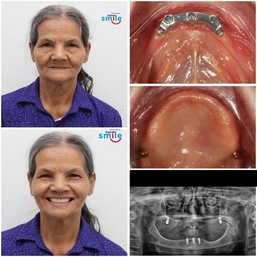 Ca phục hồi hai hàm bằng hàm tháo lắp trên implant: ảnh trước, sau, thanh bar, khớp nối và phim X-quang