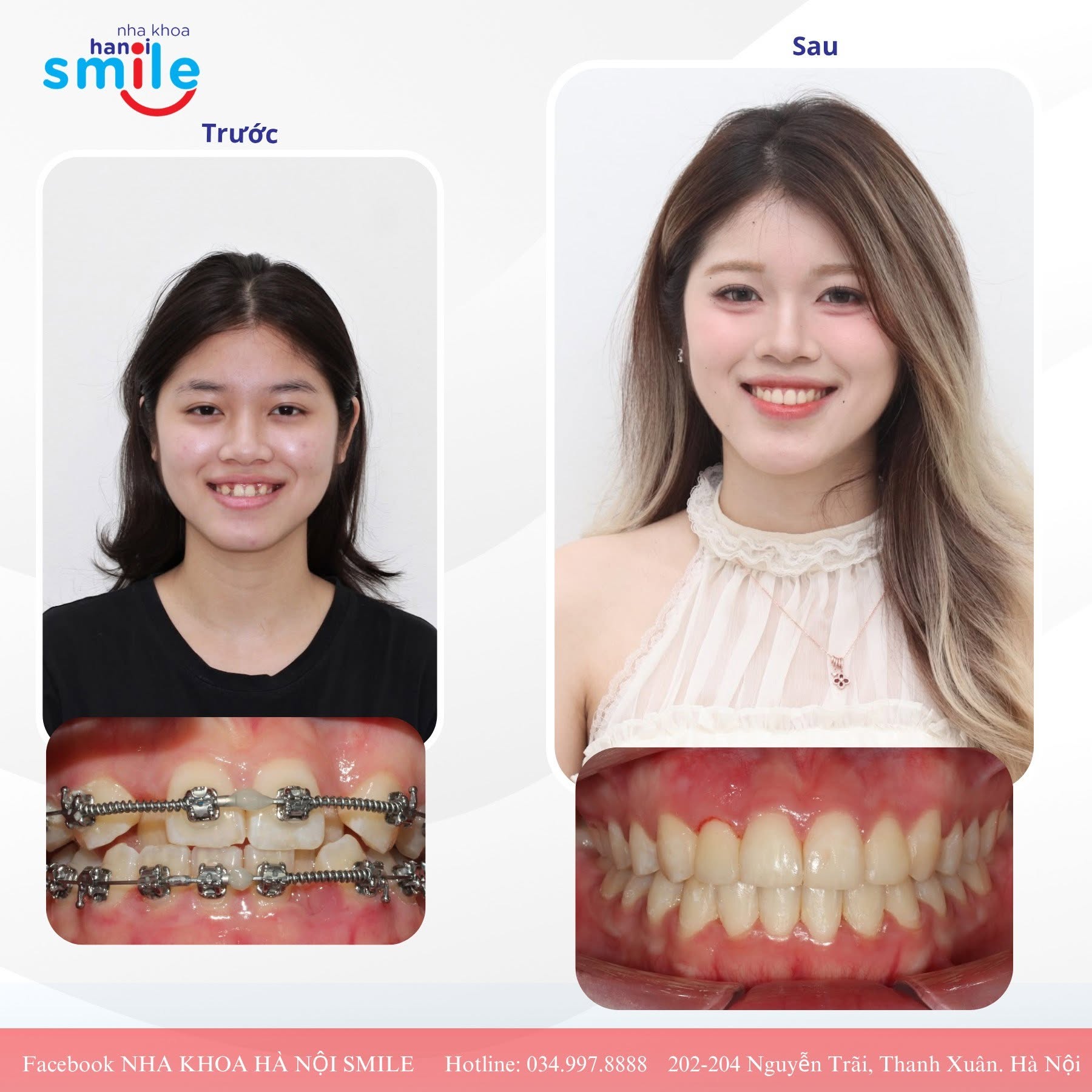 Niềng Răng Mắc Cài Kim Loại Cho Học Sinh Cấp Ba