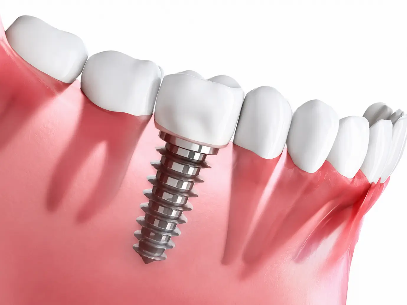 Trụ Implant Hàn Quốc