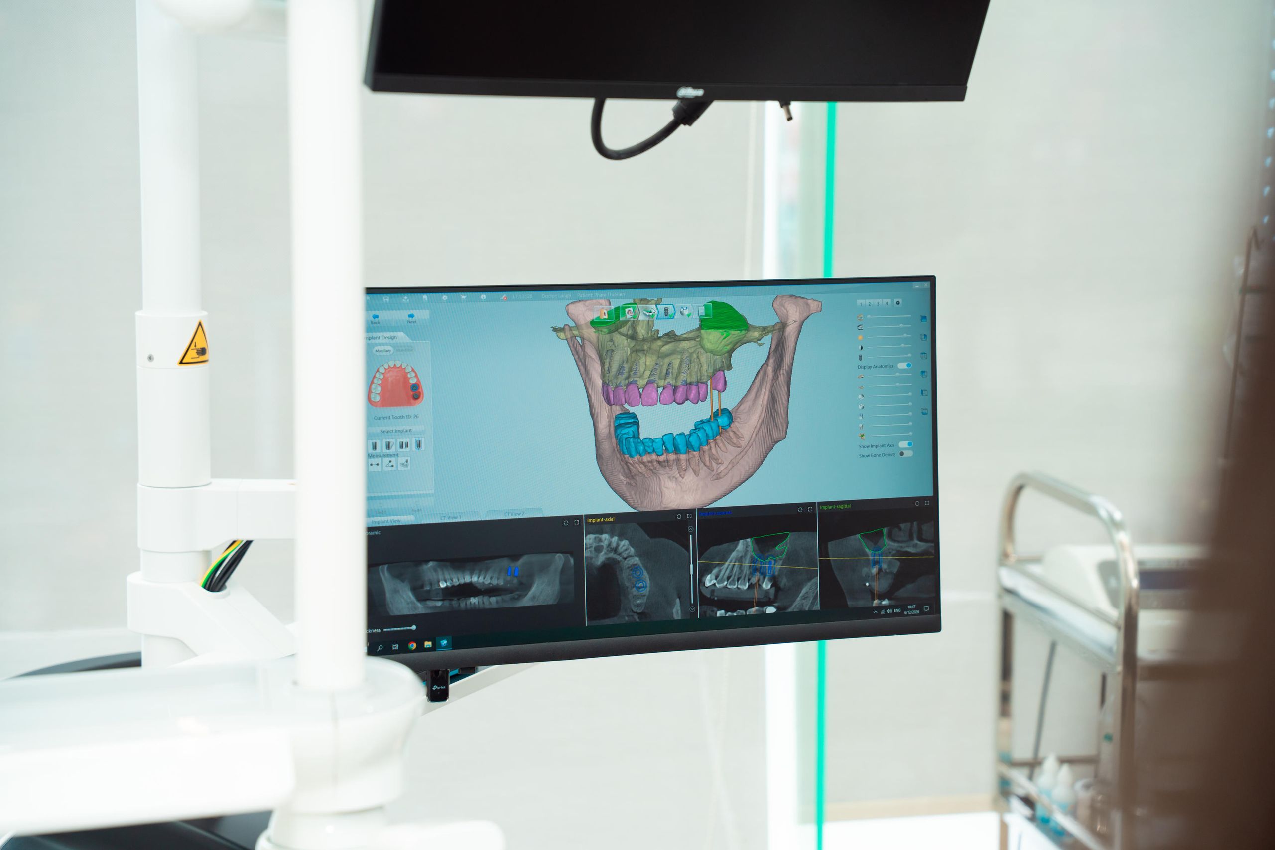 Hệ Thống Định Vị Implant Navigation