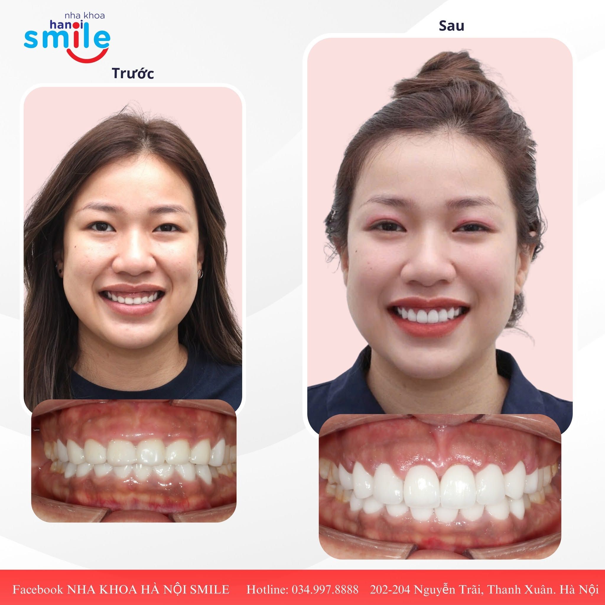 Một Số Ca Phục Hình Răng Sứ Tại Nha Khoa Hà Nội Smile