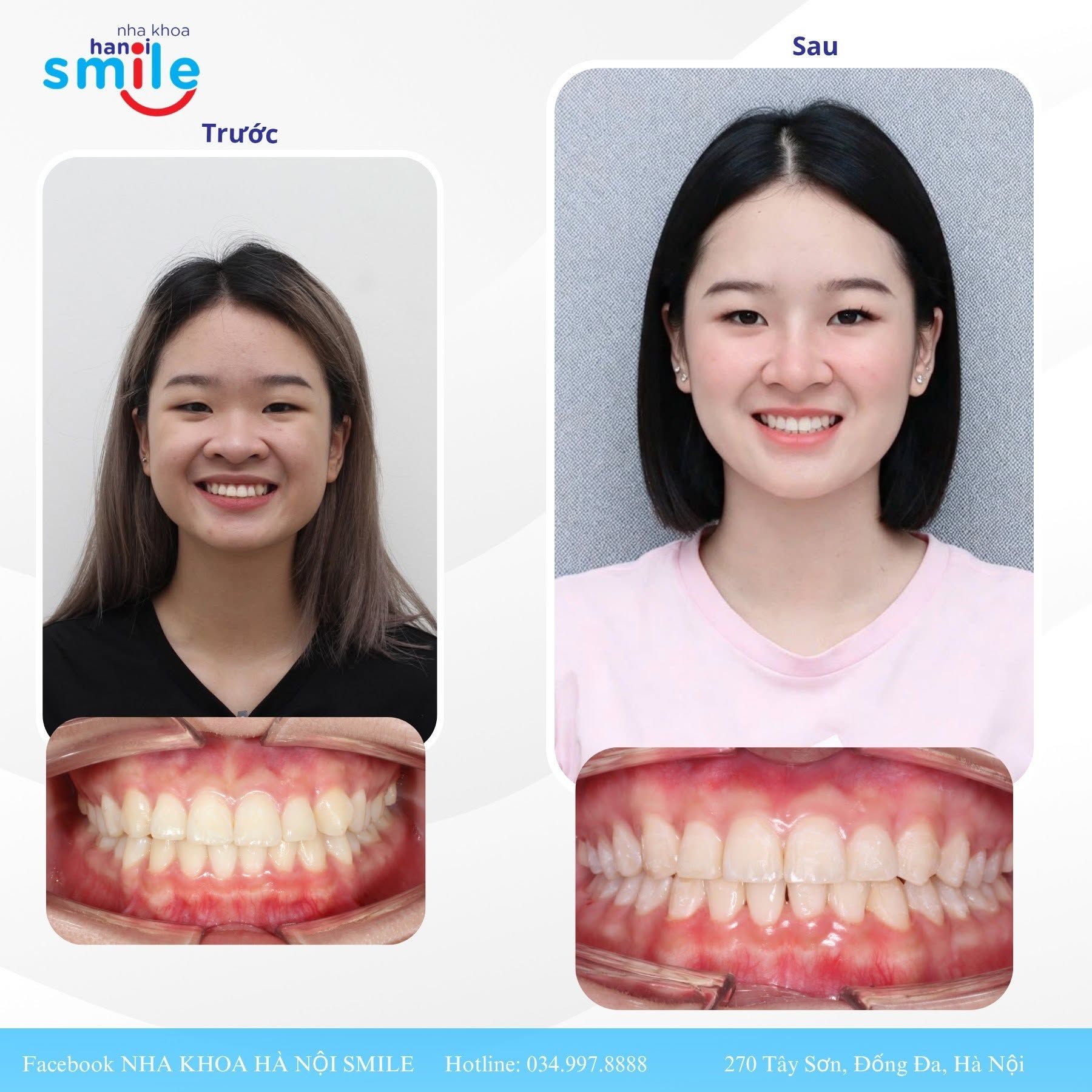 Kết Quả Chỉnh Nha: Hình Ảnh Trước Và Sau Của Hai Khách Hàng