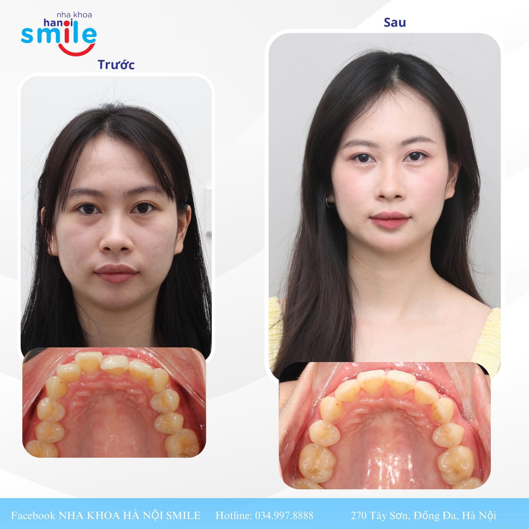 Ca chỉnh nha 2: cung răng hàm trên trước, sau điều trị