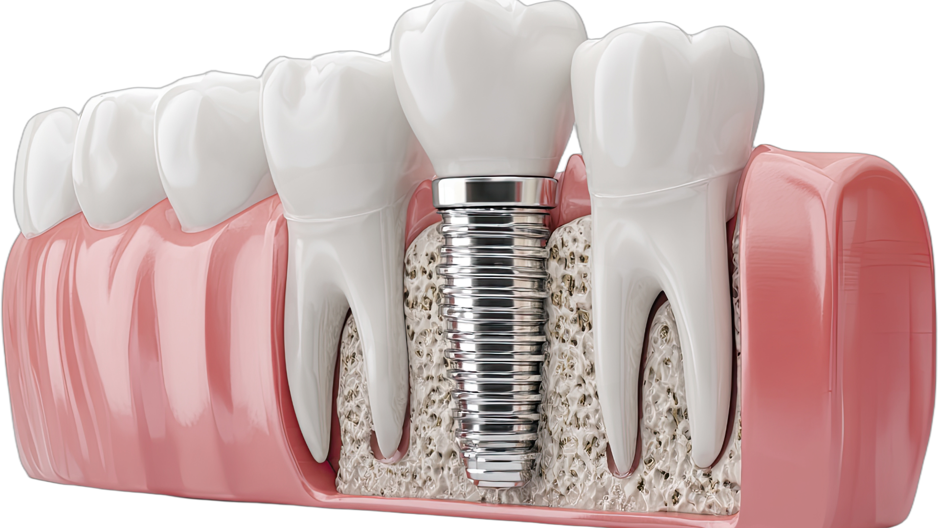 Trụ Implant Thụy Sĩ 