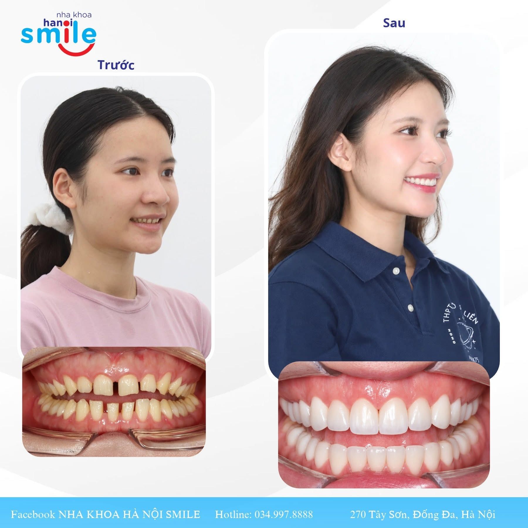 Ca răng thưa: ảnh nghiêng và khớp cắn trước, sau phục hình sứ