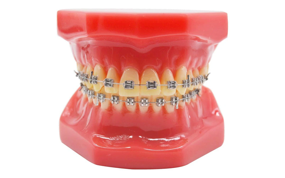 Mắc Cài Cố Định